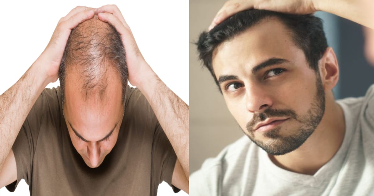 here-is-details-about-alopecia-and-baldness-problem-solution